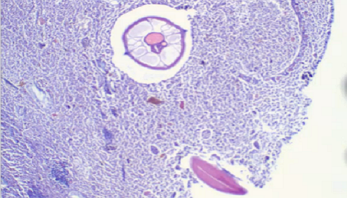  Photo of a slide of the appendix (small purple cells) with a noticeable circle separate from the tissue (the pinworm)